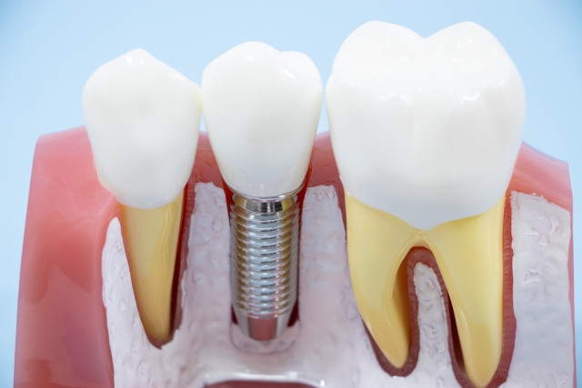 なぜ大分市でインプラントを選ぶ人が増えているのか