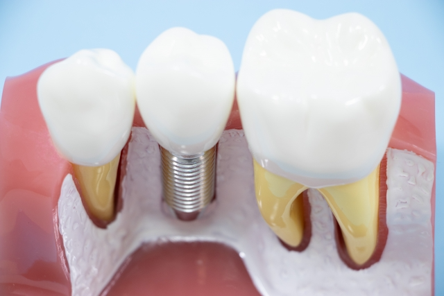 インプラントの最大のメリットは「自立していること」